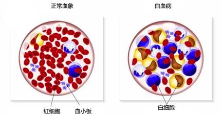 甲醛检测机构告诉你甲醛与白血病之间有着怎样的联系